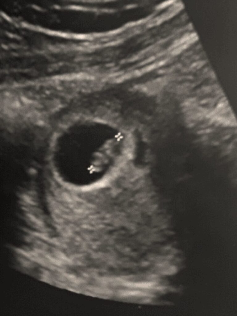 Losing Our Baby